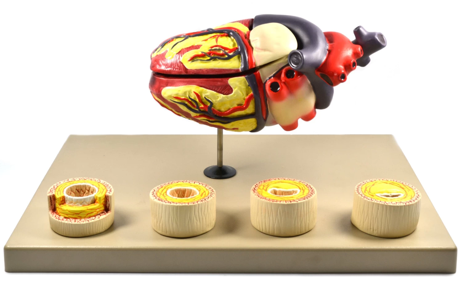 Model Of Human Heart Conditions Pathology; Larger Than Life Size (10"); Artery Cross Sections 2.5" In Diameter 1 Model Of Human Heart Conditions Pathology; Larger Than Life Size (10"); Artery Cross Sections 2.5" In Diameter